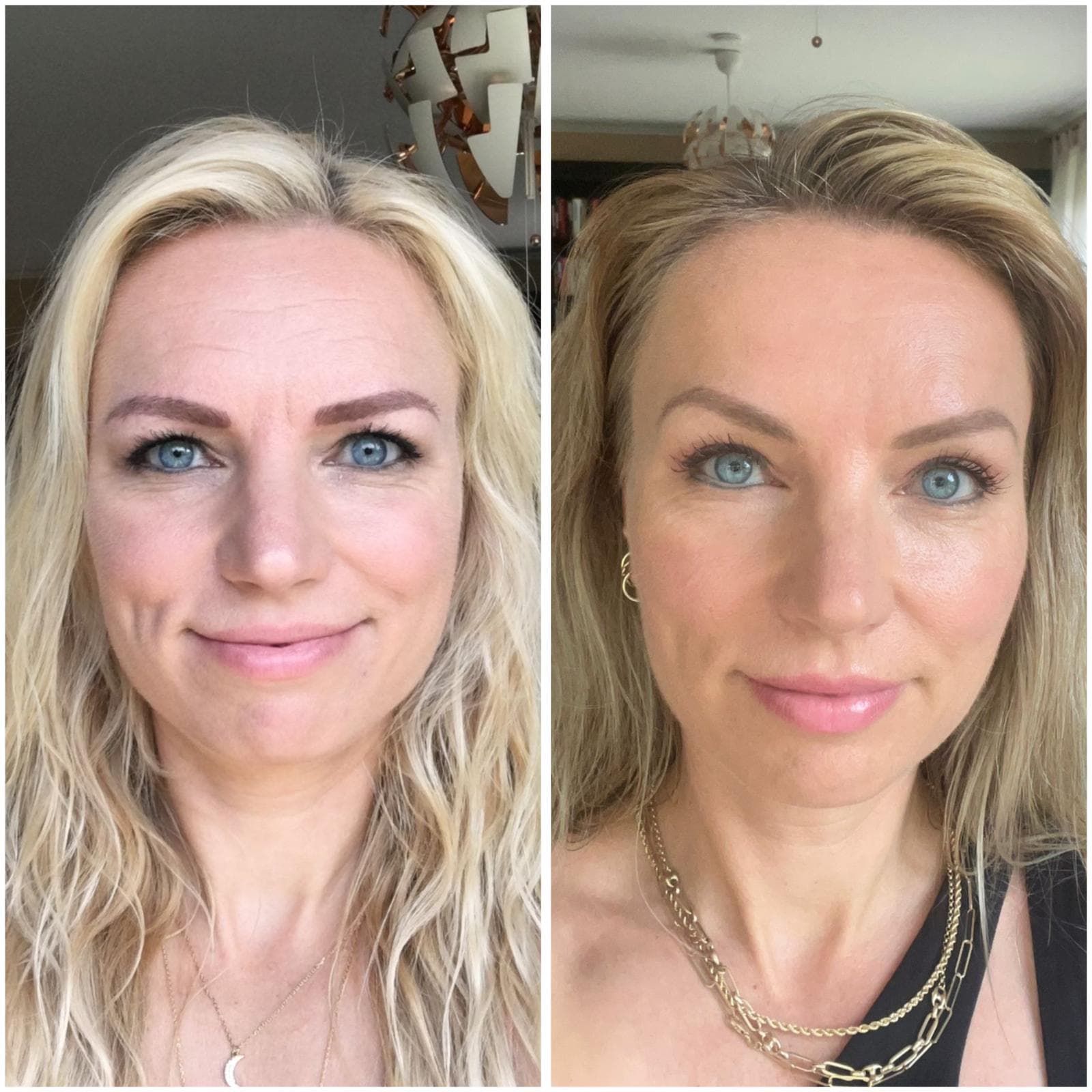 Mikroneedling Behandlung im Velvet Aesthetics Studio Berlin