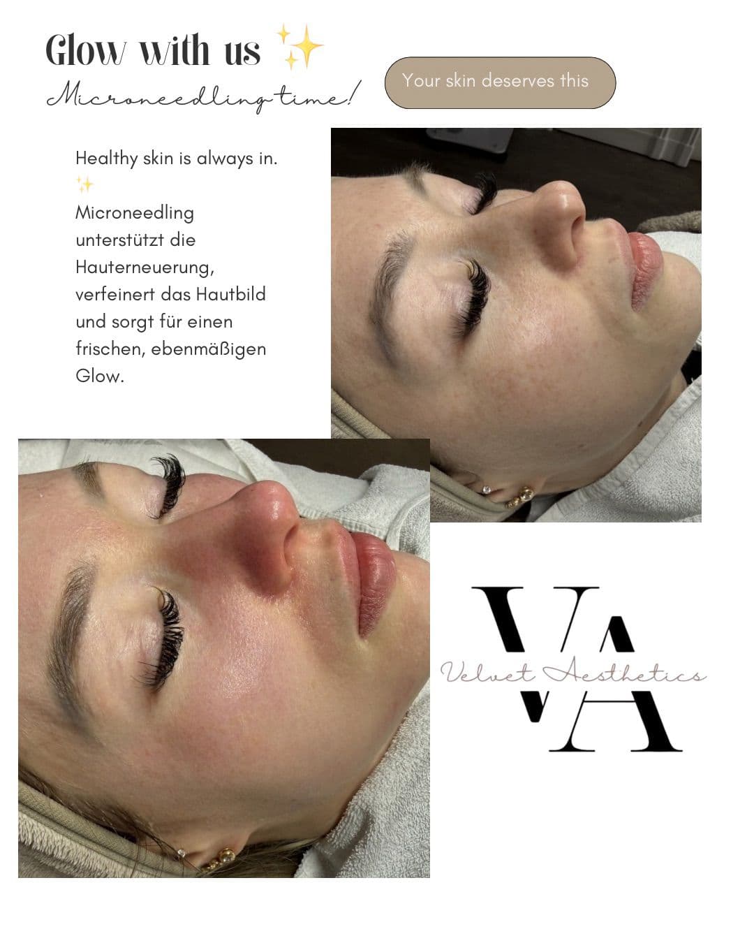 Mikroneedling Hyaluron Behandlung bei Velvet Aesthetics