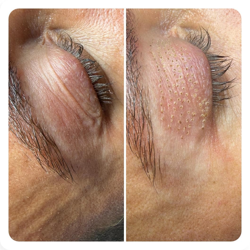 Plasma Pen Behandlung bei Velvet Aesthetics