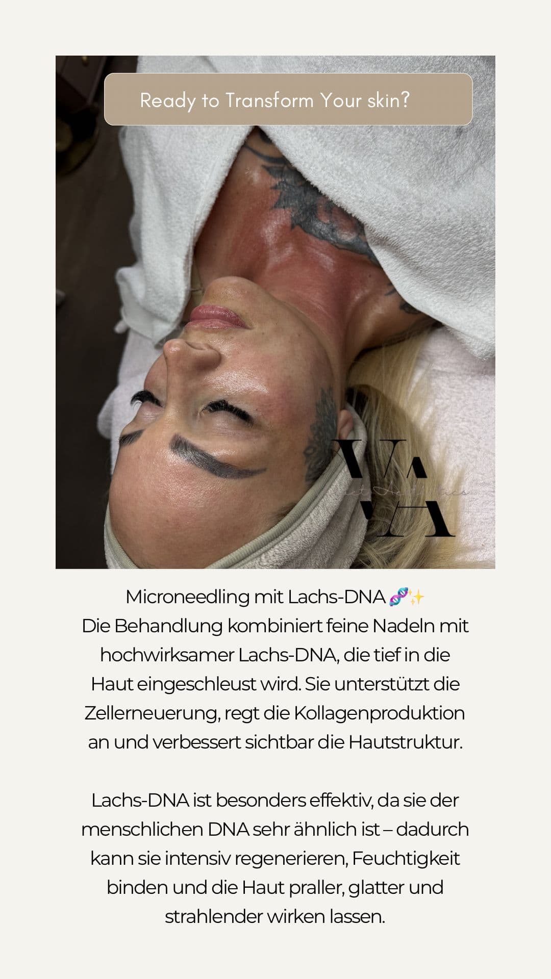 Mikroneedling Behandlung bei Velvet Aesthetics